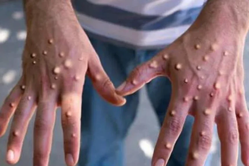 Ubushita bw’inkende (Mpox) bumaze guhitana abantu babarirwa muri 450 muri Repubulika ya Demukarasi ya Congo